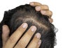 A man with both hands on his head, he stress about hair loss problems. Royalty Free Stock Photo