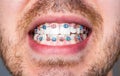 Man with braces. Bracket system in smiling mouth, macro photo teeth, close-up lips, macro shot, dentist. Close to the Royalty Free Stock Photo