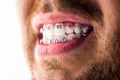 Man braces. Teeth braces on the white teeth of man to equalize the teeth. Bracket system in smiling mouth, macro photo Royalty Free Stock Photo