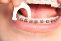 Man with braces using dental floss for hygiene