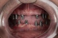 man cavity protected by retractor showing perfect teeth.implants and pressed ceramic crowns Royalty Free Stock Photo