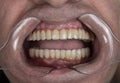 man cavity protected by retractor showing perfect teeth.implants and pressed ceramic crowns Royalty Free Stock Photo