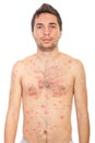 Man with chickenpox Royalty Free Stock Photo