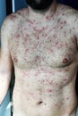 Man with chickenpox Royalty Free Stock Photo