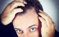 Man controls hair loss Royalty Free Stock Photo