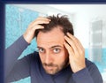 Man controls hair loss Royalty Free Stock Photo