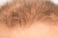 Man controls hair loss Royalty Free Stock Photo