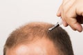 Man controls hair loss Royalty Free Stock Photo