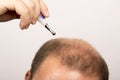 Man controls hair loss Royalty Free Stock Photo