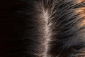 A Man with dandruff in dark hair, Top view Dandruff on the hair. Hair disease seborrhea. Fatty Dandruff Royalty Free Stock Photo