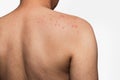 Man with dermatitis problem of rash Royalty Free Stock Photo