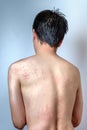 Man with dermatitis problem of rash