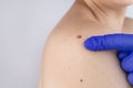 A man at a dermatologist appointment shows his birthmarks, moles and nevi. The doctor examines the patient with a dermatoscope.