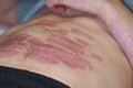The body of a man is covered with extensive psoriasis. A man lies on his back and on his psoriasis.