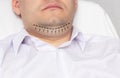 A man with a double chin in the office of a plastic surgeon. Marking with a black dash-dot line marker for double chin
