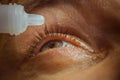 A man drips open human eye with bright red arteries drops to improve vision close up. irritation and redness of the eyeball.