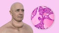 A man with enlarged thyroid gland, 3D illustration, and micrograph toxic goiter