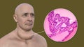 A man with enlarged thyroid gland, 3D illustration, and micrograph toxic goiter