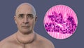 A man with enlarged thyroid gland, 3D illustration, and micrograph toxic goiter
