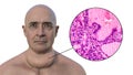 A man with enlarged thyroid gland, 3D illustration, and micrograph toxic goiter