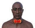 A man with enlarged thyroid gland, 3D illustration