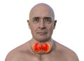 A man with enlarged thyroid gland, 3D illustration