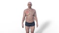 A man with erythema migrans in Lyme disease, 3D animation