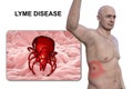 A man with erythema migrans, a characteristic rash of Lyme disease caused by Borrelia burgdorferi, 3D illustration