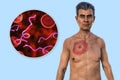 A man with erythema migrans, a characteristic rash of Lyme disease caused by Borrelia burgdorferi, 3D illustration