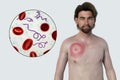 A man with erythema migrans, a characteristic rash of Lyme disease caused by Borrelia burgdorferi, 3D illustration