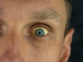 Man eyes obstructive Jaundice yellow discoloration Real people liver dysfunction icteruswith cirrhosis hepatitis symptom