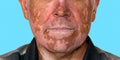 A man face with with vitiligo on blue background