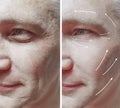 man face effect wrinkles treatment arrow before and after procedures therapy medicine Royalty Free Stock Photo