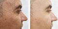 man face wrinkles before and after hydrating cosmetology rejuvenation treatments