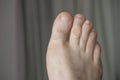 A man feet with corn remover pad on the second finger Royalty Free Stock Photo