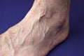 A man foot with a mesh of dilated varicose veins stands on a blue background