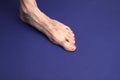 A man foot with a mesh of dilated varicose veins stands on a blue background