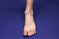 A man foot with a mesh of dilated varicose veins stands on a blue background