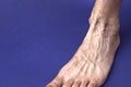 A man foot with a mesh of dilated varicose veins stands on a blue background