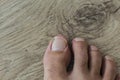 Man foot nail toe