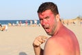 Man getting sunburned at the beach Royalty Free Stock Photo