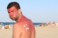 Man getting sunburned at the beach Royalty Free Stock Photo