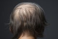 Man hair loss. Generate Ai