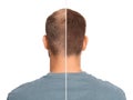 Man with hair loss problem before and after treatment on white background, collage. Visiting trichologist