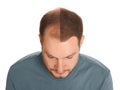 Man with hair loss problem before and after treatment on white background, collage. Visiting trichologist