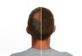 Man with hair loss problem before and after treatment on white background, collage. Visiting trichologist