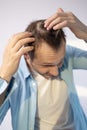 Man with hair loss problems closeup, isolated. Alopecia balding hairs on man scalp.