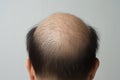Man hair loss treatment. Generate Ai Royalty Free Stock Photo