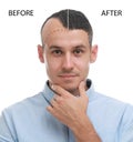 Man before and after hair loss treatment on white background, collage Royalty Free Stock Photo