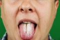 Man with halitosis for Candida albicans on tongue